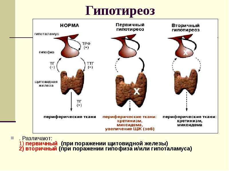 Причины развития гипотиреоза / edpro