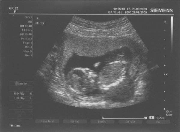 13 неделя беременности :: polismed.com