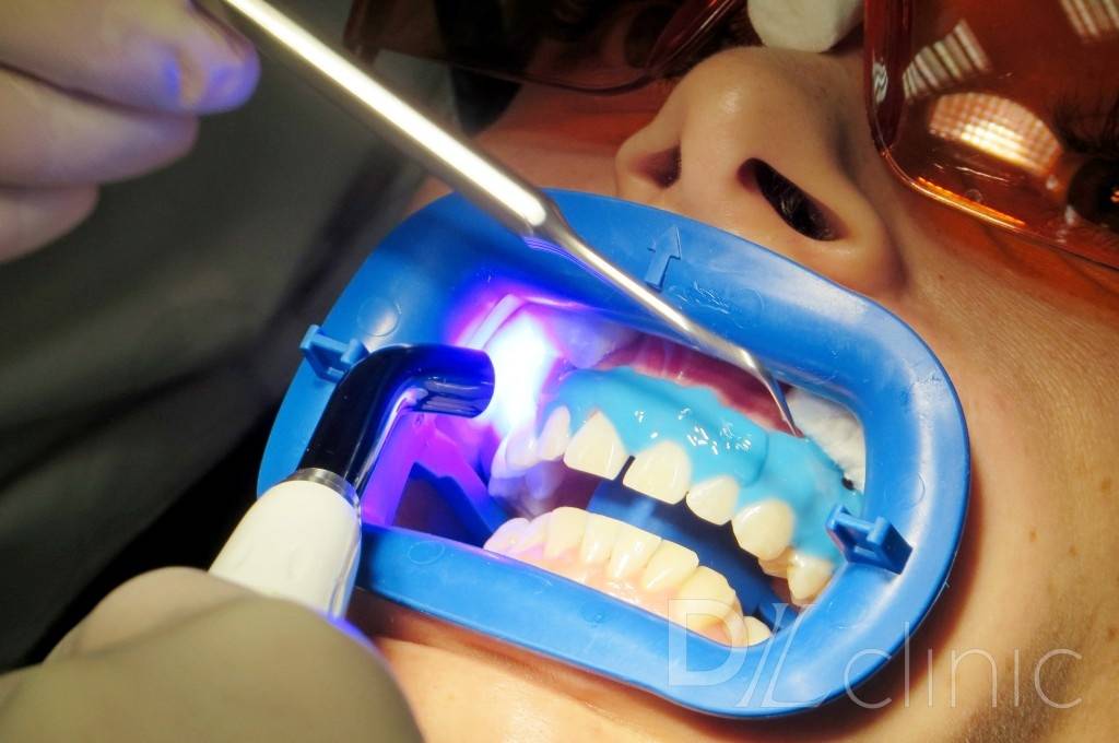 процедура лазерного отбеливания зубов