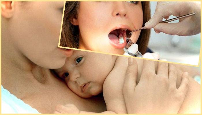 Лечение зубов в период кормления грудью