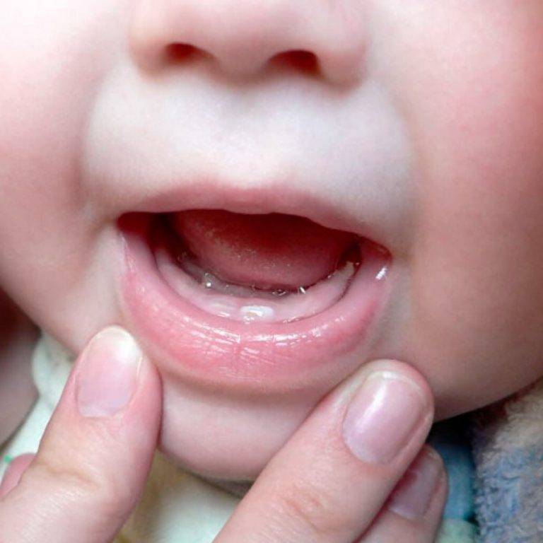У ребенка криво растут молочные зубы: что делать если передние и нижние зубы растут криво
