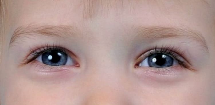 Причины синяков под глазами: почему появляются, откуда берутся, что означают, как от них избавиться