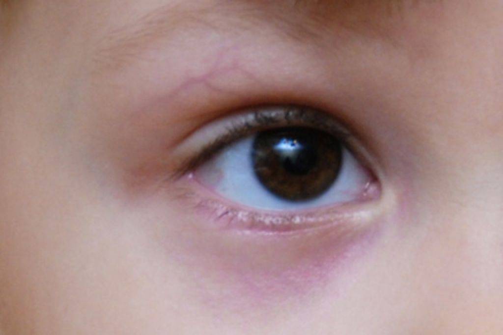 Круги под глазами у ребенка | eurolab | педиатрия
