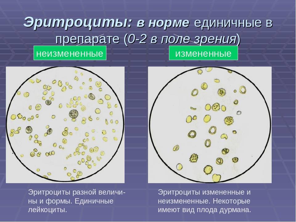 Лейкоциты в поле зрения. Измененные (дисморфные) эритроциты в моче. Измененные и неизмененные эритроциты в микроскопии мочи. Неизмененные эритроциты в моче микроскопия. Эритроциты в моче изменённые в поле зрения.