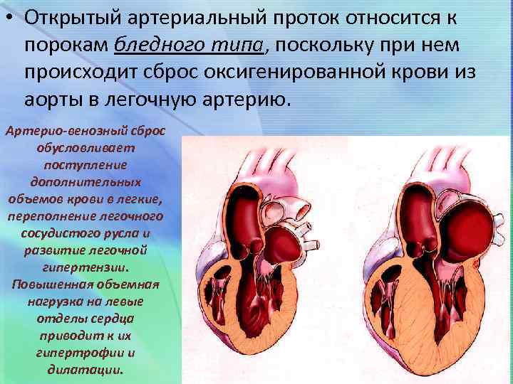Пороки сердца у детей: аневризма межпредсердной перегородки — медицинский центр «целитель»
