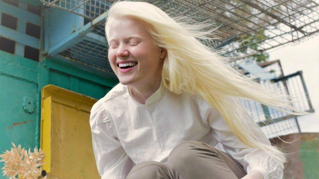 Какие бывают альбиносы. «белая ворона», или особенности здоровья и развития ребенка-альбиноса