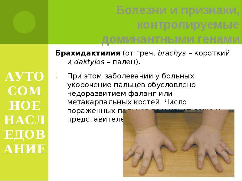 Брахидактилия (короткопалость) — причины, симптомы и лечение аномалии развития рук и ног