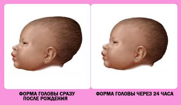Большой родничок у новорожденного: когда зарастает, нормы, патология