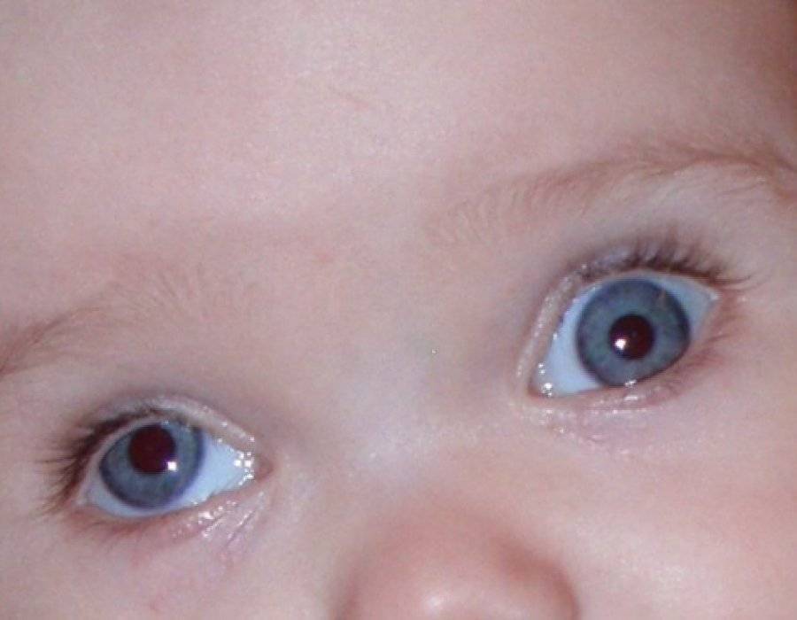 Новорожденный косит глазами - симптомы, профилактика, лечение, причины