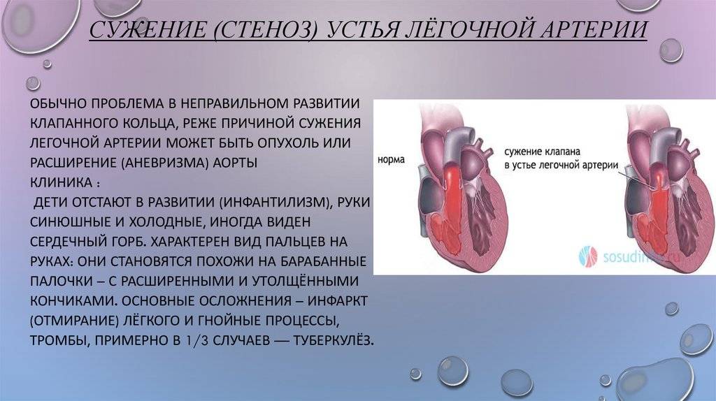 Диагностика и лечение пороков сердца у детей (александров)