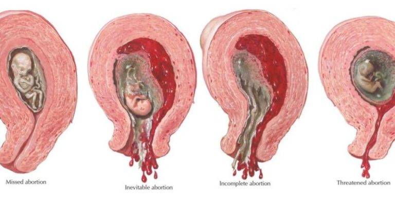 Неразвивающаяся беременность: причины, патогенез, симптомы, последствия, лечение