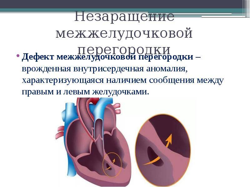 Дефект межжелудочковой перегородки презентация