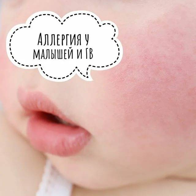 Аллергия у детей - как проявляется, чем лечат