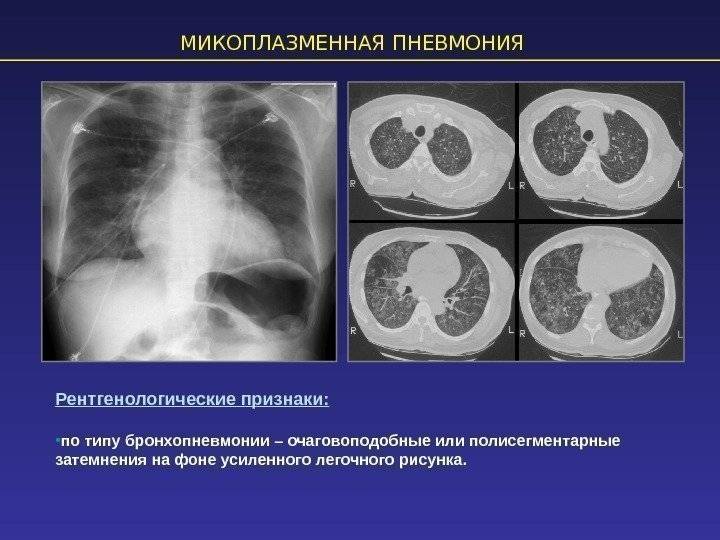 Что значит атипичная пневмония у детей