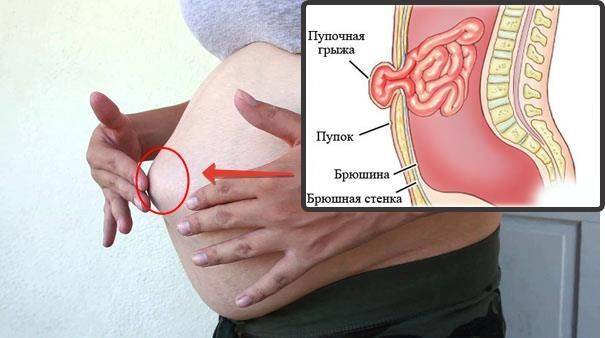 Рвота при беременности: что делать при рвоте? когда рвота при беременности действительно опасна?