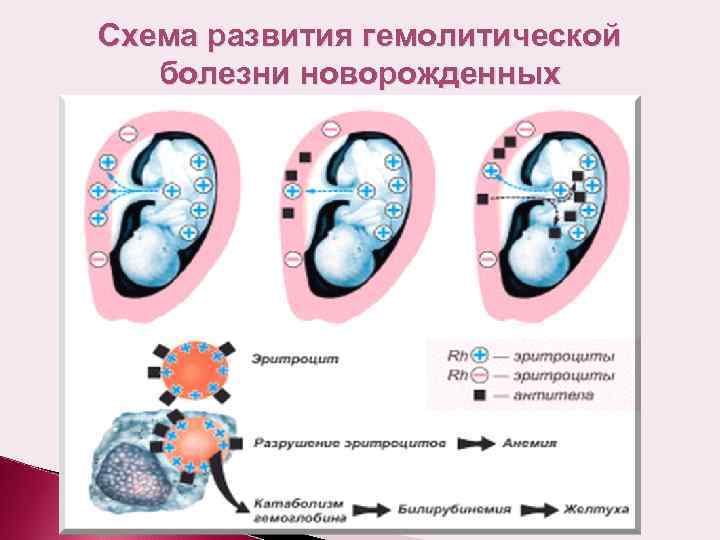 Гемолитическая болезнь новорожденного                (эритробластоз плода, фетальный эритробластоз)