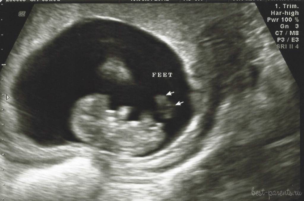 Фото ребенка в 9 недель беременности фото узи