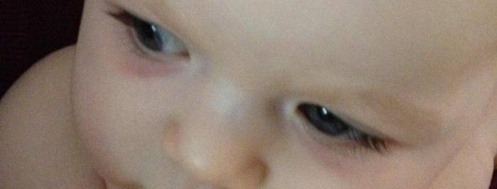 У ребенка синяки и круги под глазами — что говорит комаровский