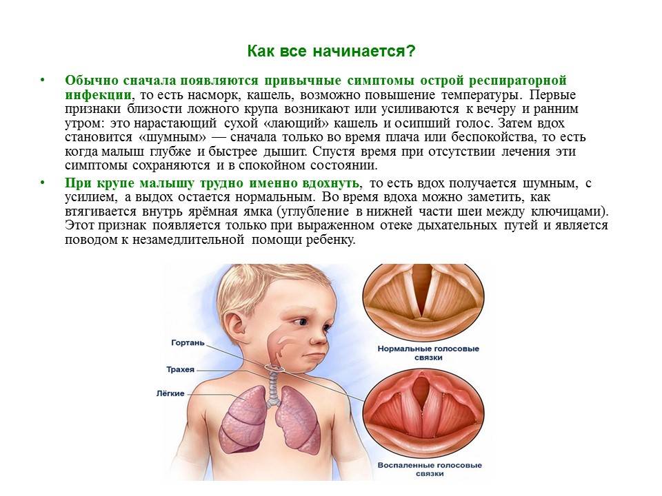 Ларинготрахеит у детей - причины, симптомы, диагностика и лечение в челябинске и екатеринбурге