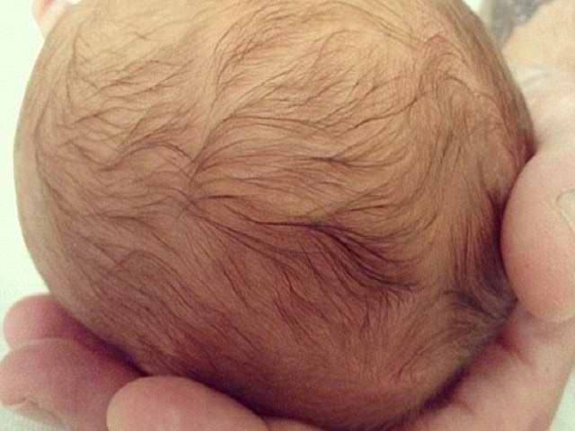 Молочные корочки на голове у новорожденного: как убрать себорейные корочки у грудничка