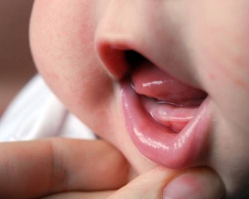 Когда появляются первые зубы у младенцев симптомы фото и видео
