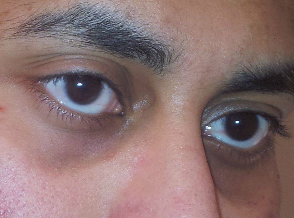 Почему у грудничков появляются синяки под глазами