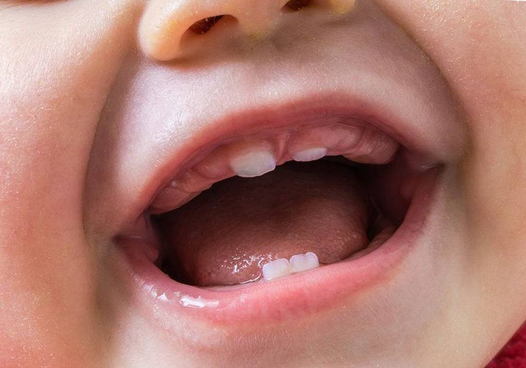 Крошатся зубы у ребенка: в чем причина, как лечить, как предотвратить разрушение