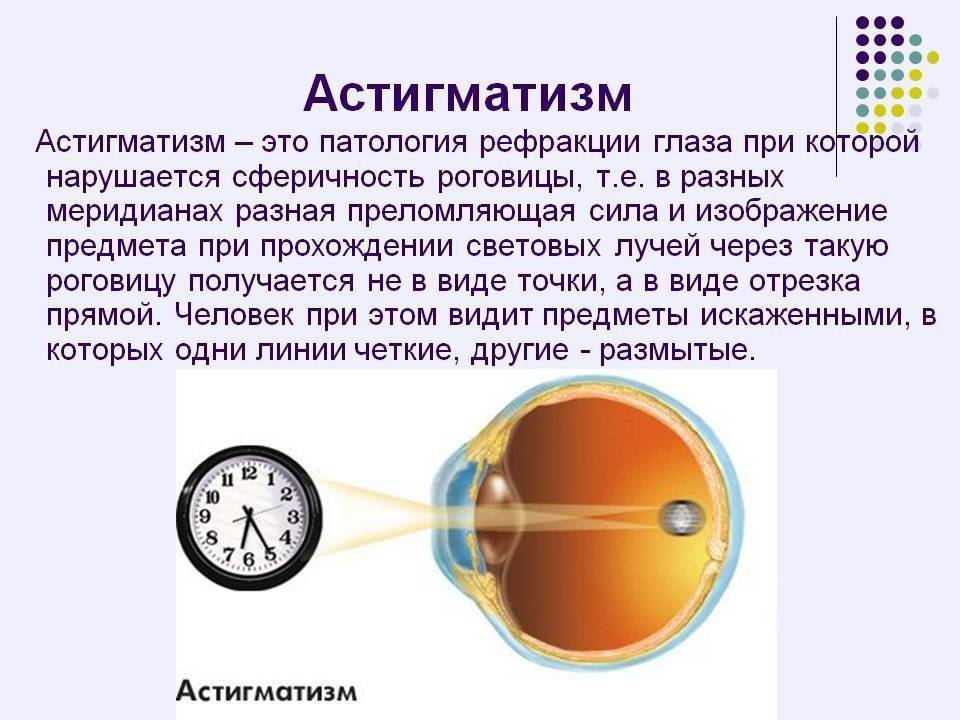 Дальнозоркий астигматизм у детей, лечение сложного дальнозоркого астигматизма в fedorovmedcenter