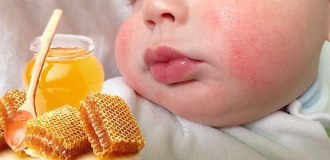 Аллергия у младенцев при кормлении грудью