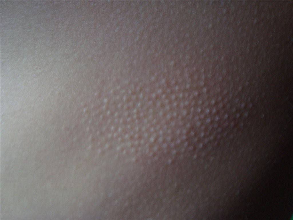 Гусиная кожа у ребенка — возможные причины появления