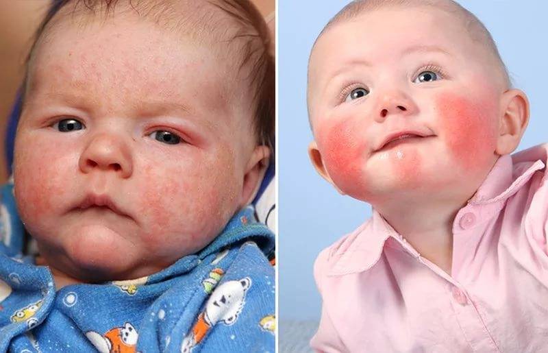 Первые признаки аллергии у младенцев
