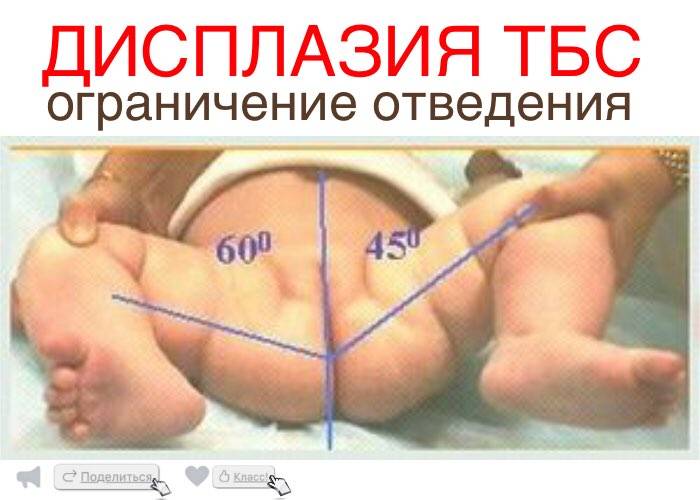 Дисплазия тазобедренных суставов у детей и новорожденных - medside.ru