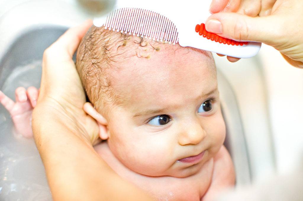 Выпадение волос у новорожденных и грудных детей