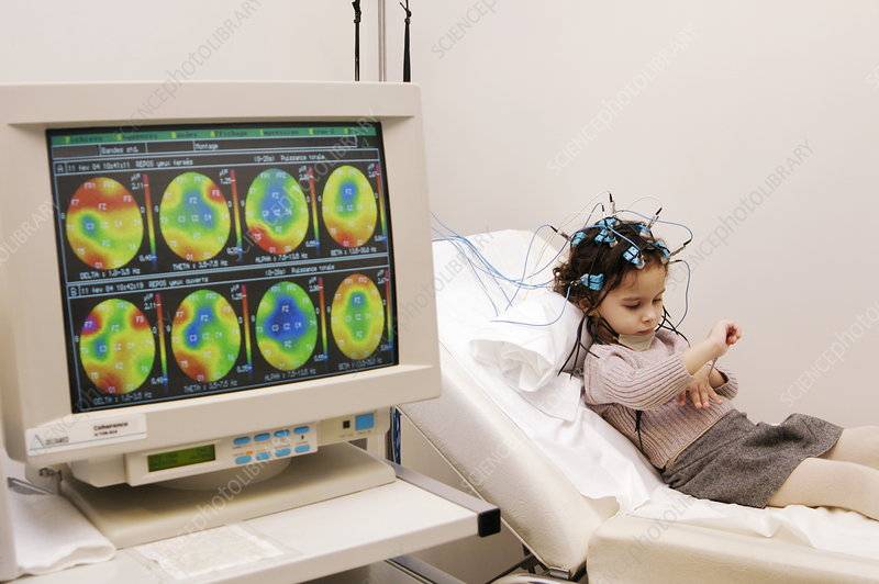 Что такое энцефалограмма головного мозга
