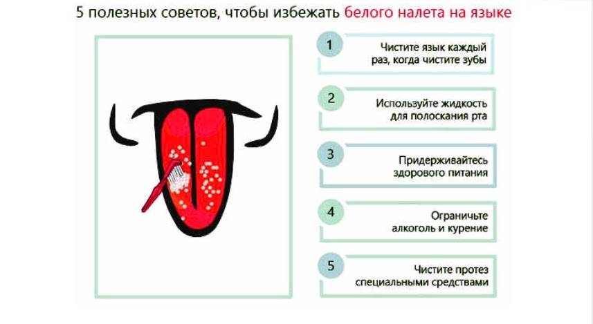 Кандидоз полости рта - симптомы болезни, профилактика и лечение кандидоза полости рта, причины заболевания и его диагностика на eurolab