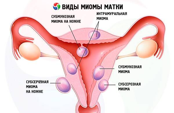 Аденомиоз матки: что это и как лечить - статья репродуктивного центра «за рождение»