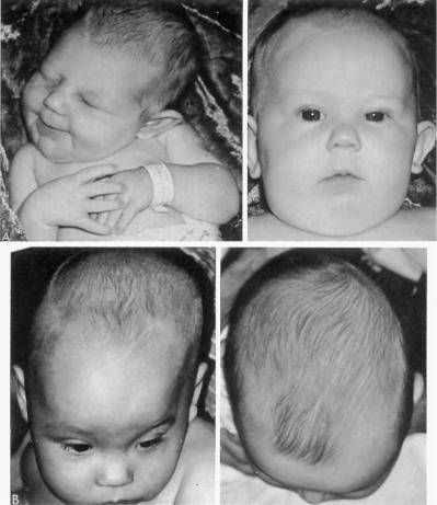 Лечение деформации головы у детей