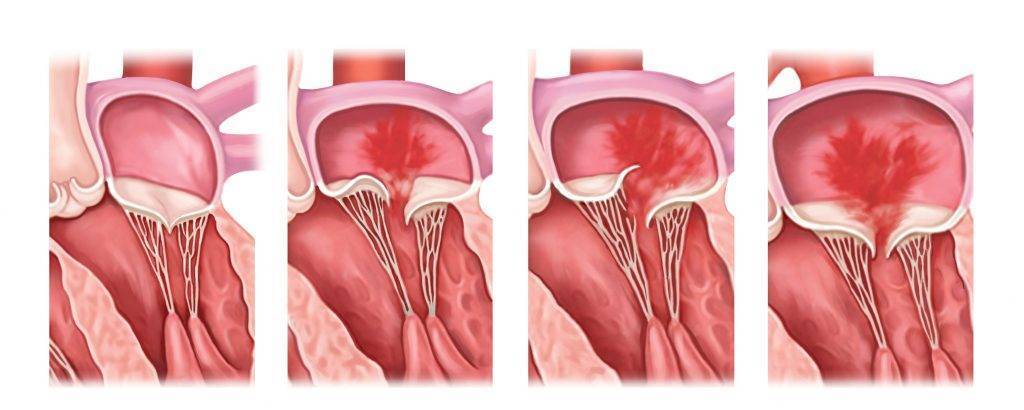 Пролапс митрального клапана картинка