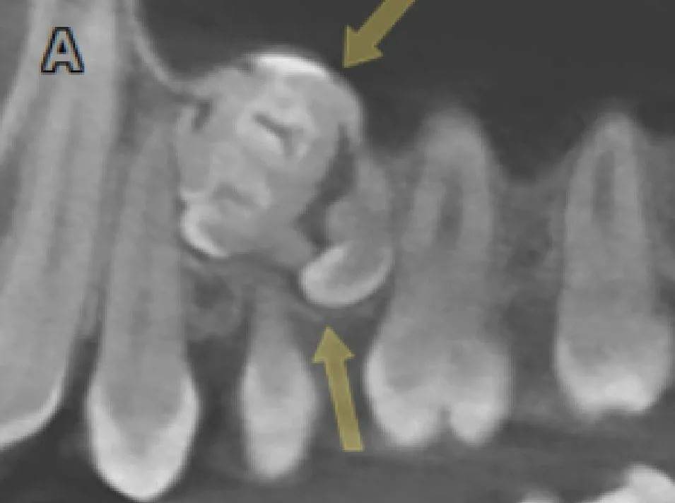Можно ли делать рентген зуба при беременности (на ранних сроках и поздних)