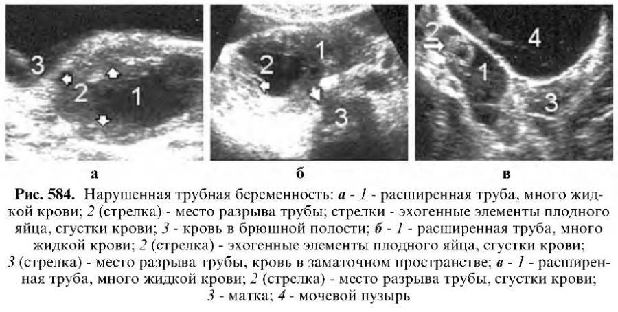 Морфологическая картина неразвивающейся беременности