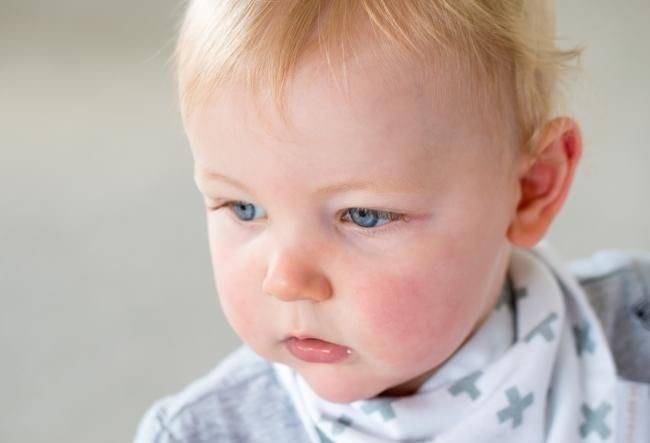 Что такое аллергия? аллергия у ребенка. можно ли вылечить аллергию? -симптомы