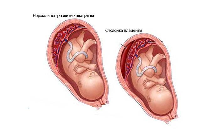 Отслойка плаценты на поздних сроках беременности: причины и последствия