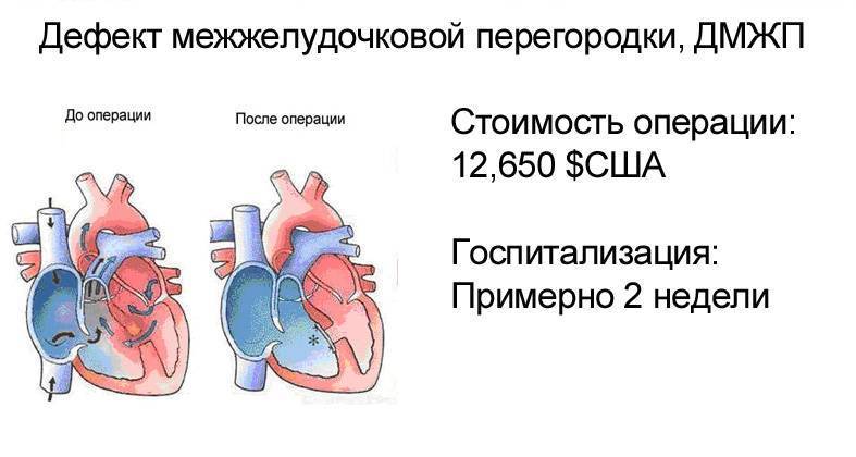 Эндоваскулярное лечение порока сердца