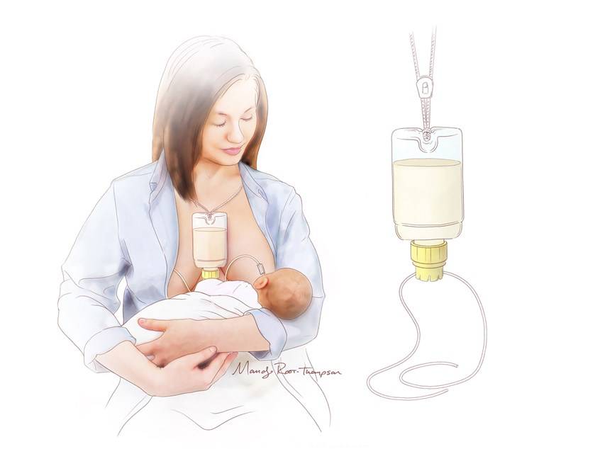 Система докармливания для грудничка своими руками. дополнительная система кормления (sns). реальные истории кормящих мам с sns