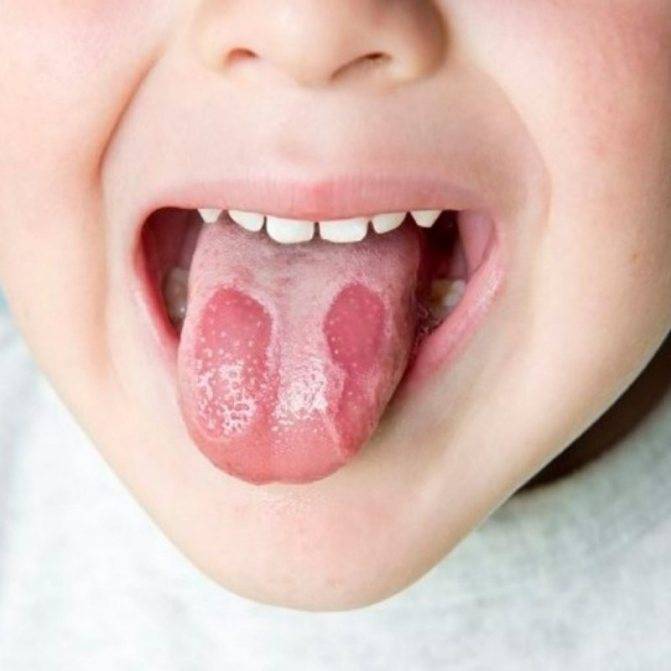 Лейкоплакия полости рта: симптомы, дифференциальная диагностика, виды и лечение