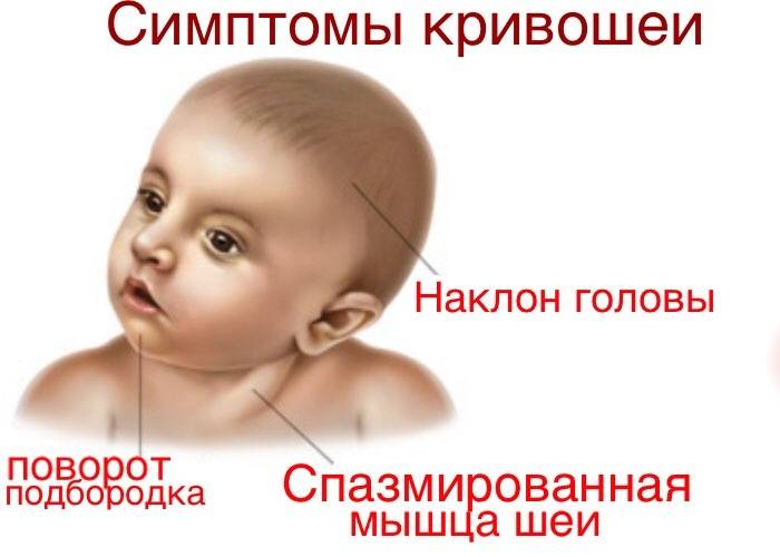 Операция при кривошее в москве, проведение операции при кривошее у детей в клинике цэлт.