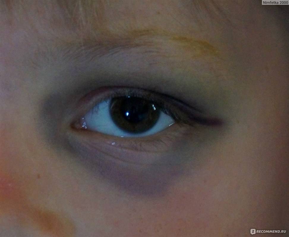 Причины синяков под глазами у ребенка