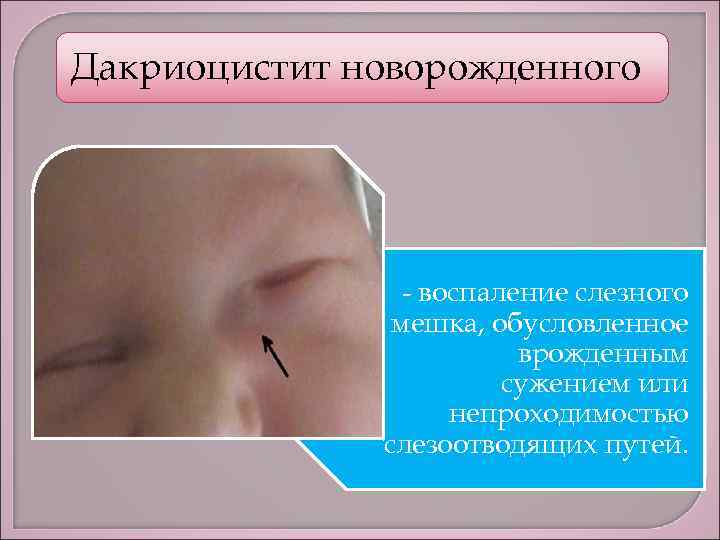 Слезоточивость глаз: лечение, диагностика, профилактика | клиника санта