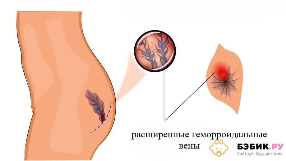 Геморрой внутренний и внешний. симптомы, признаки, стадии геморроя у мужчин и у женщин.