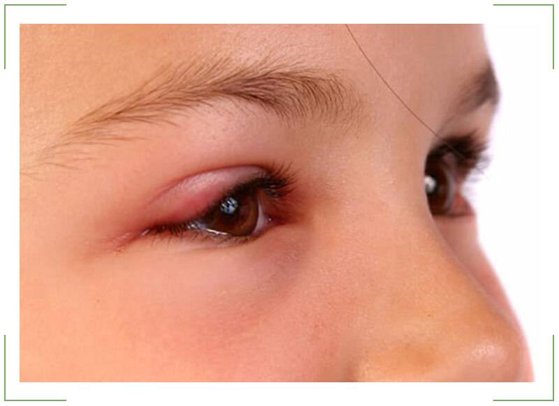 Ячмень на глазе. симптомы, причины и лечение ячменя на глазе